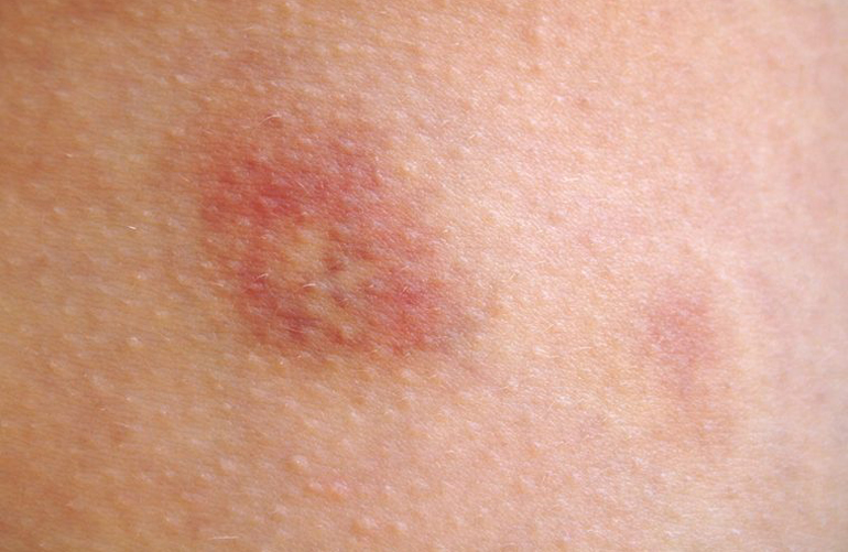 There are tender red bumps under your skin