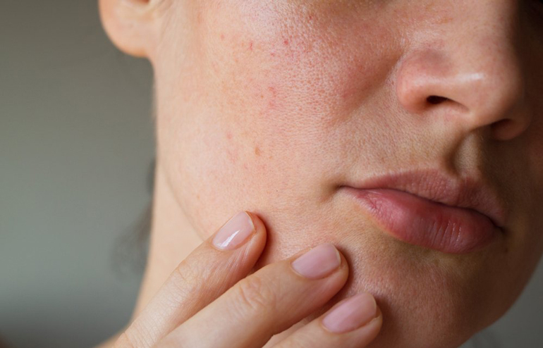 Sebum is layering itself all over your face