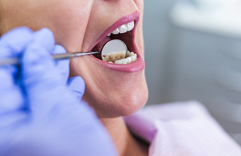 Damage to your teeth