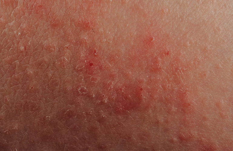 Itchy, blistery skin rash