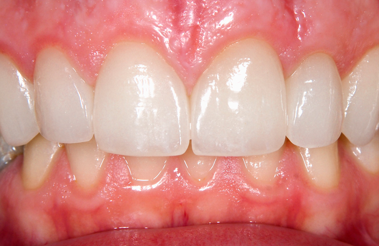 Inflamed gums