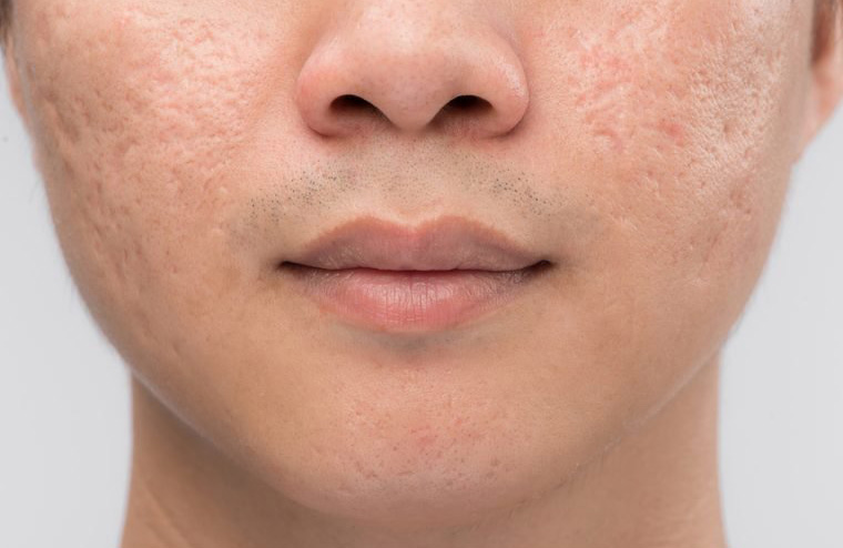 Acne can be related to diet