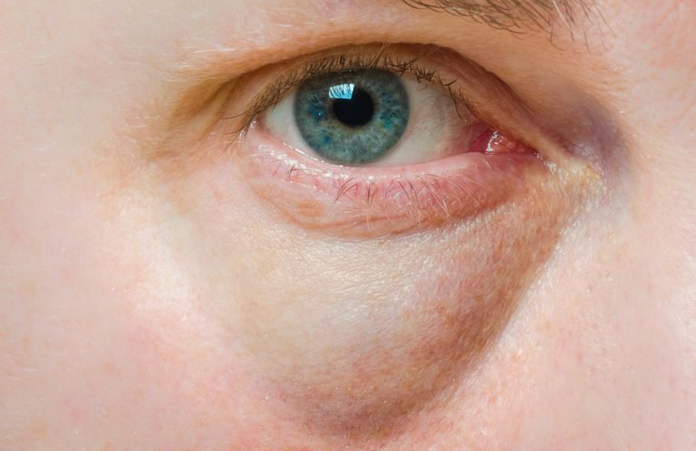 Puffy eyes could mean kidney disease or a sluggish thyroid