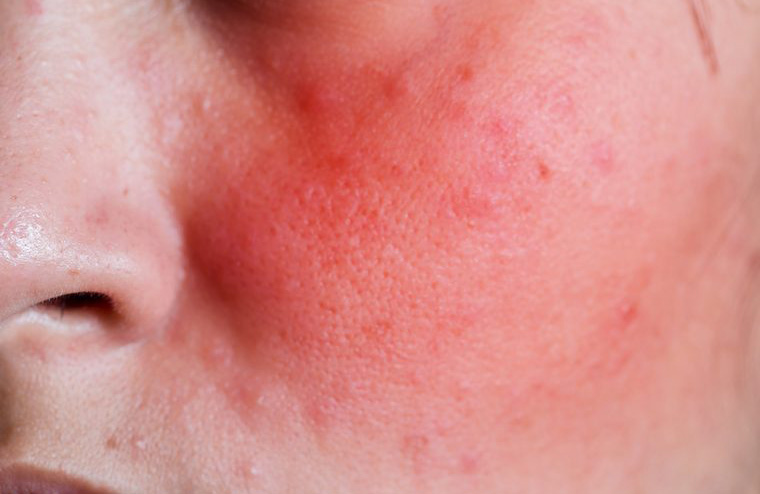 A red face can mean hypertension