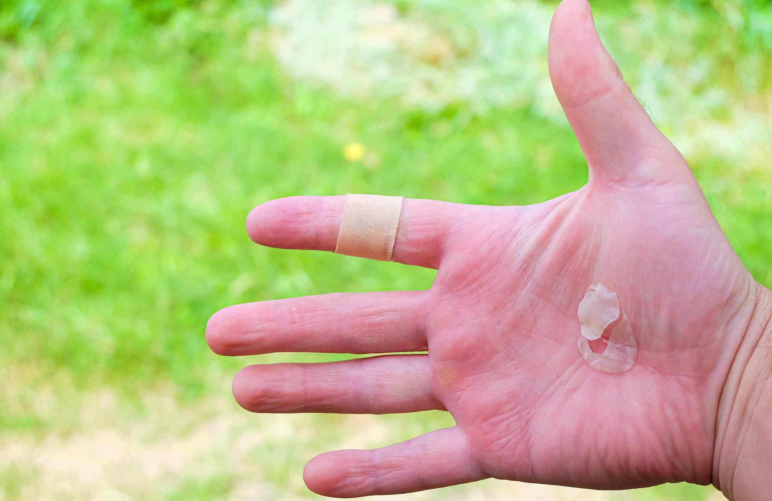 Rubbing alcohol use: Popping a blister