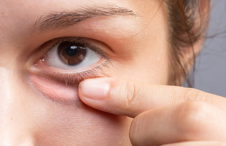 Rings around your eyes could mean you’re sick