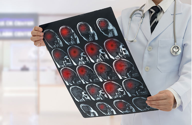 Preventing stroke
