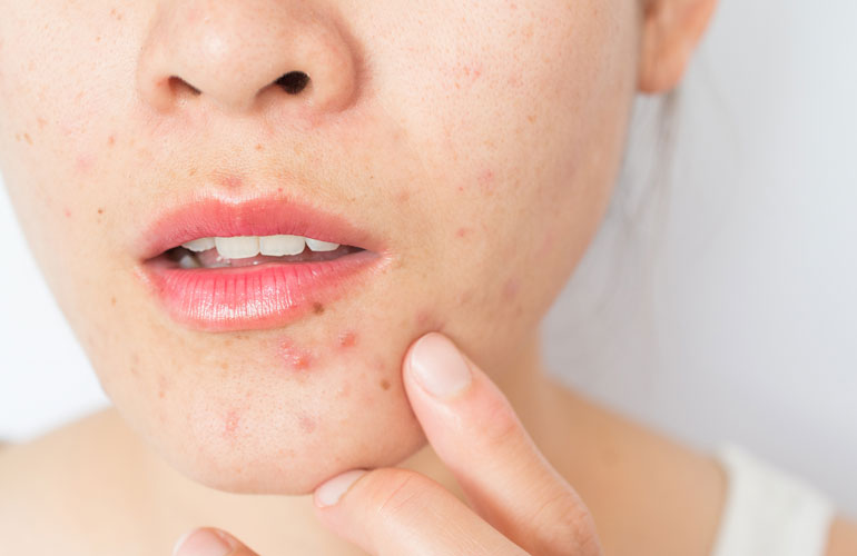 Improving acne