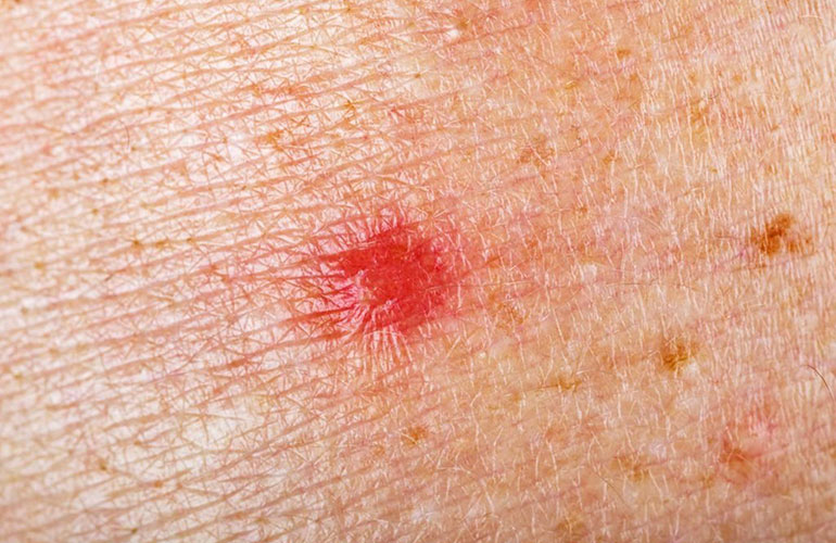 Red spots or bruises