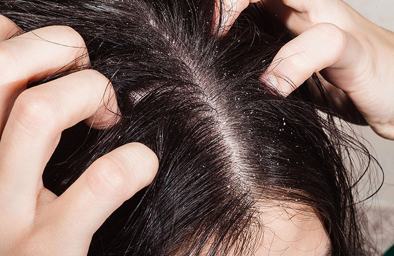 Treating dry scalp
