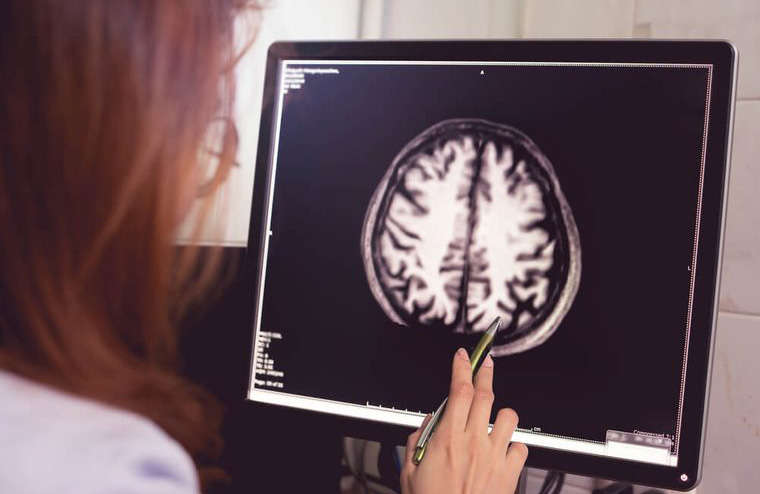 Alzheimer’s disease
