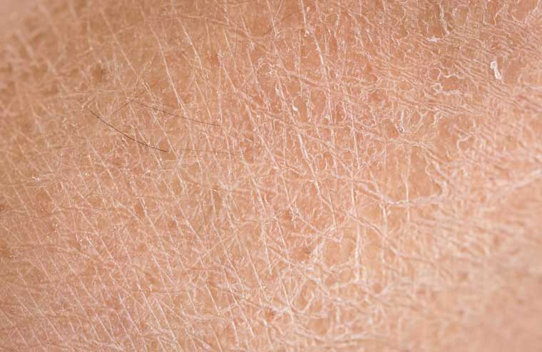 Rough and dry skin