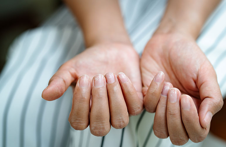 Your nails are brittle