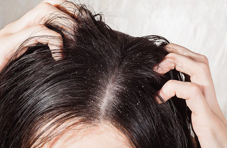 Bacteria on your scalp