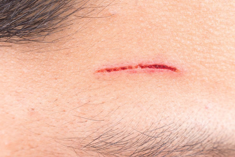 Redness around the affected area persists