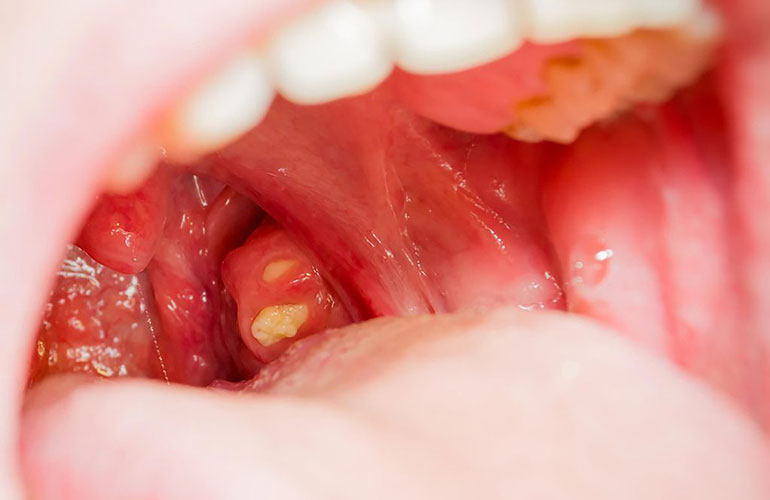 Tonsils