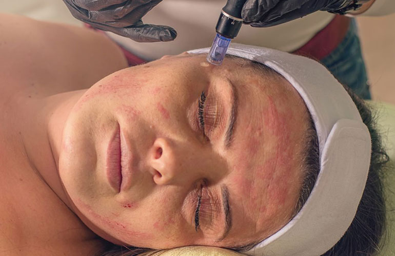Vampire facial
