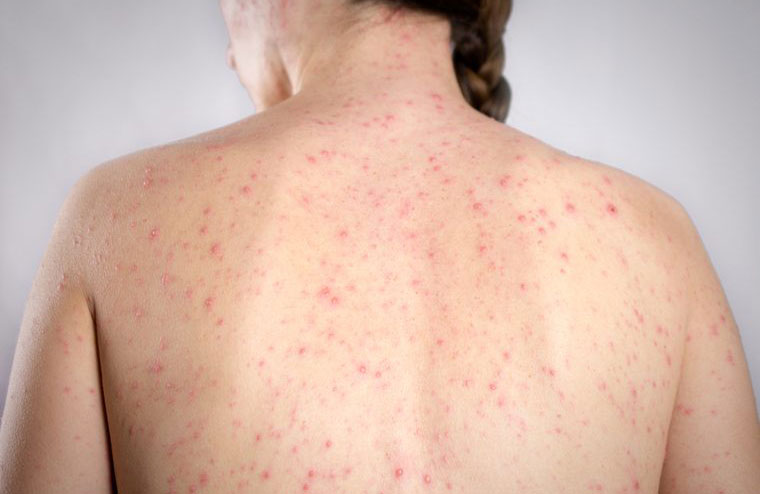 Measles