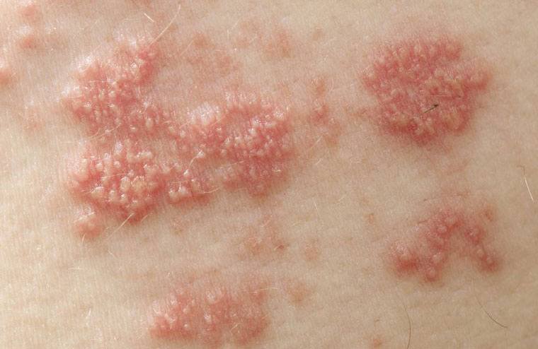 Leprosy