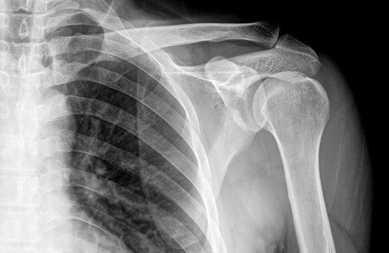X-rays