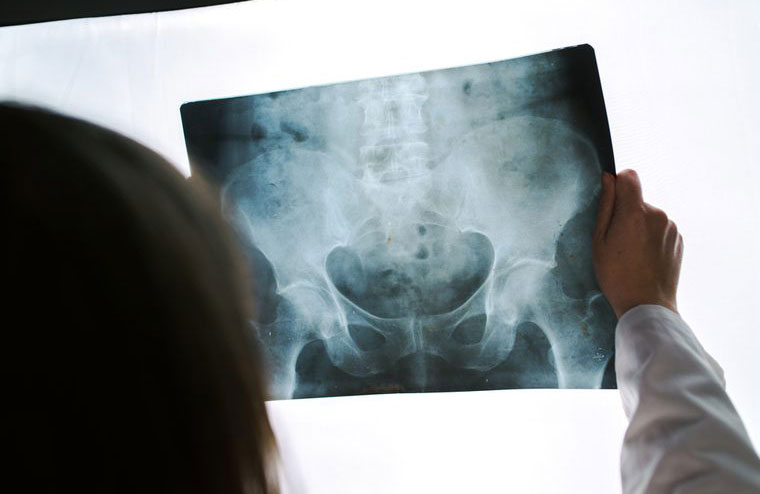 Your bones become more fragile
