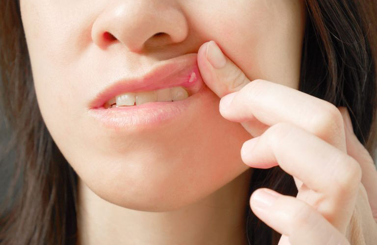Soothe mouth ulcers