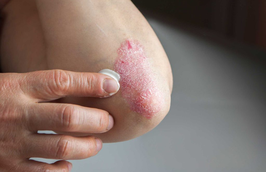 A recurring scaly patch