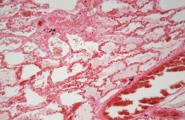 Pneumonia
