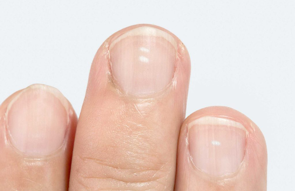 White spots on nails