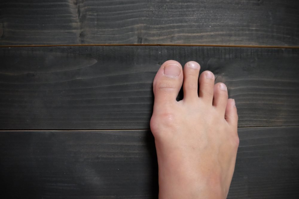 Sometimes if a bunion is really bad, a patient will ask me to amputate her second toe