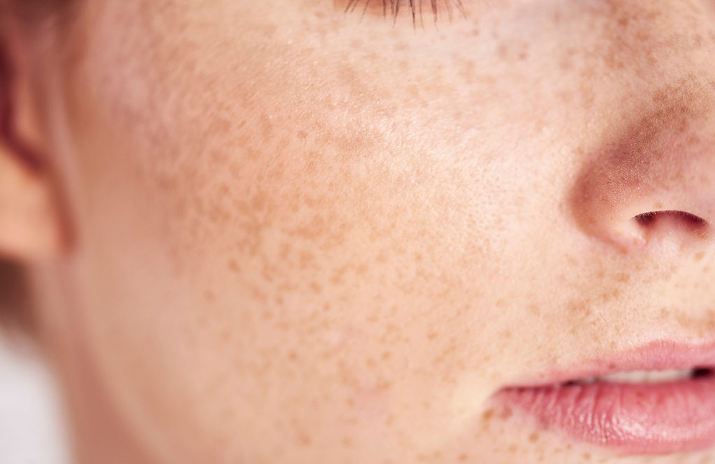 A change in a freckle or beauty mark