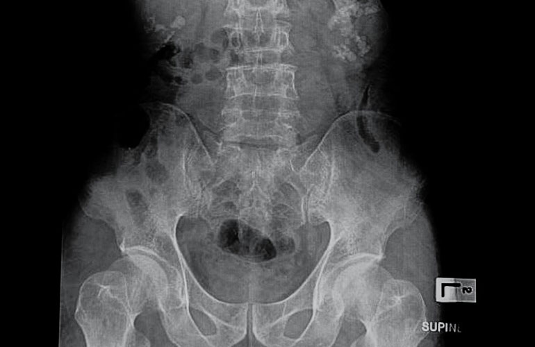 How kidney stones are diagnosed and treated