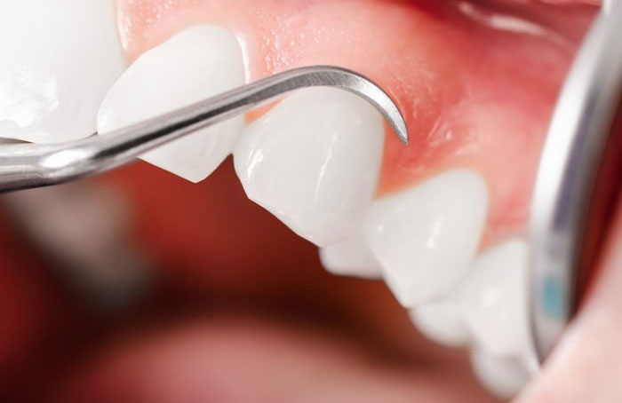 Gums