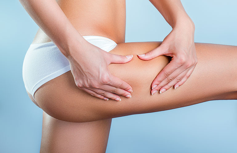 What is cellulite?