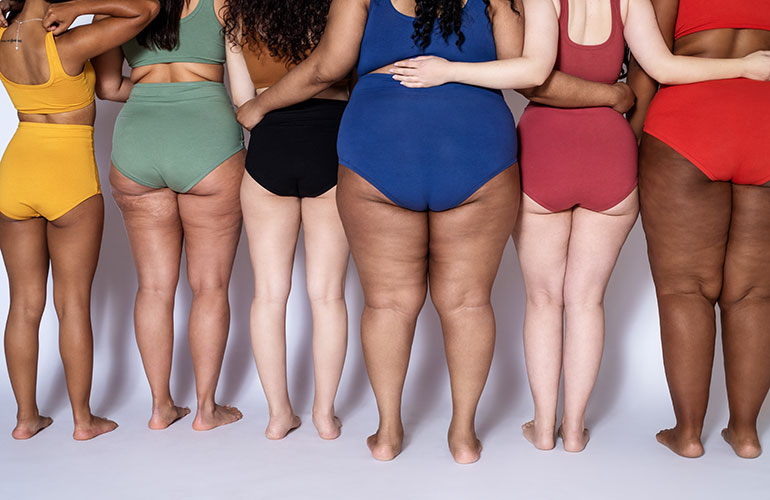 Almost every woman has cellulite