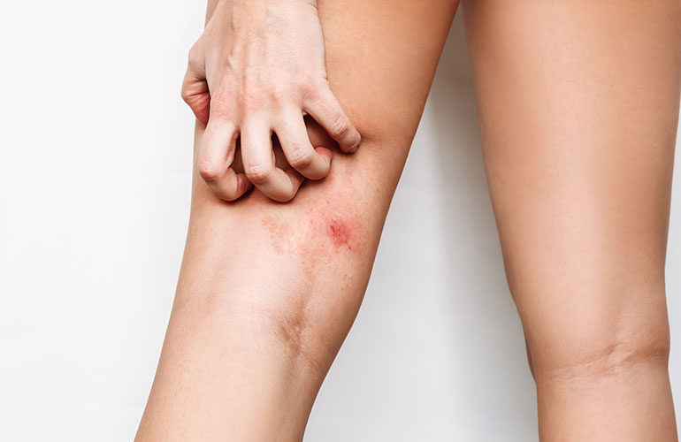 Your skin gets patchy in places