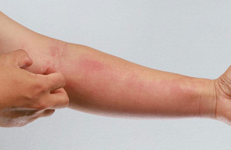 Help heal eczema and skin rashes
