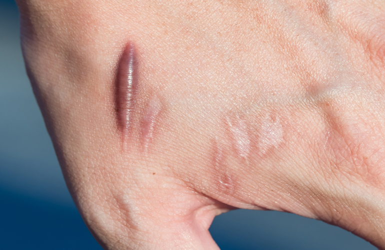 Is it a keloid?