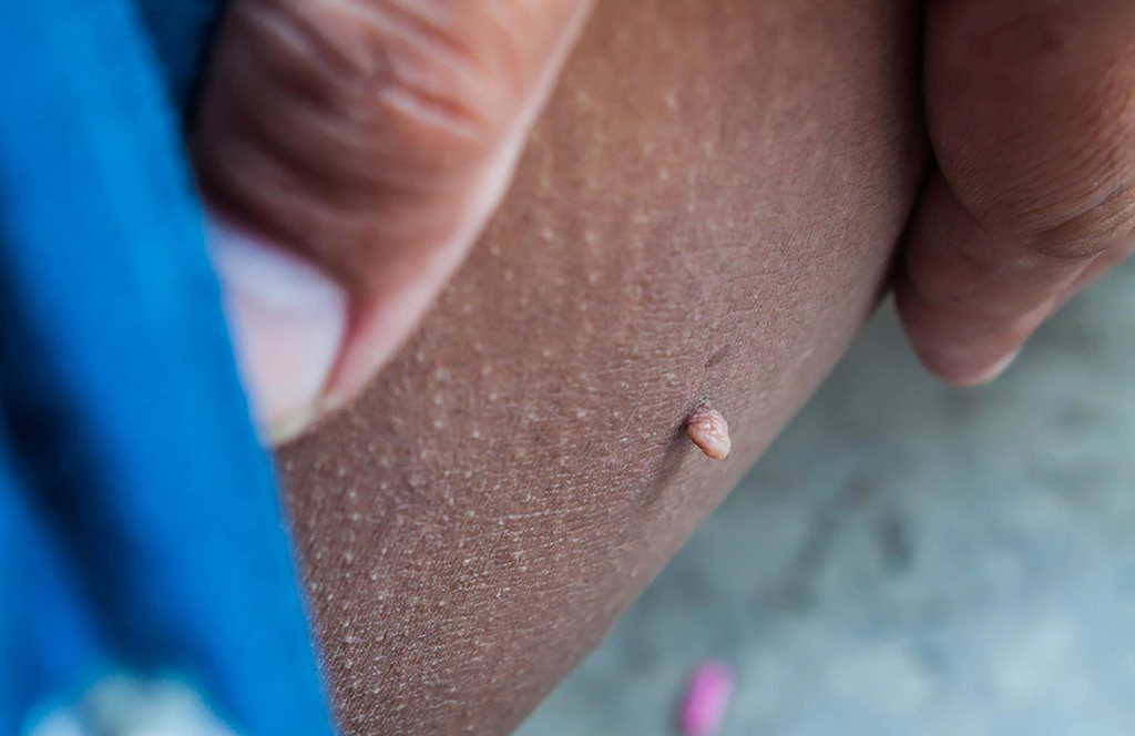 Is it a skin tag?
