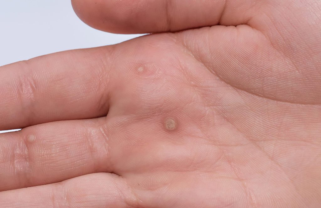 Is it a wart?