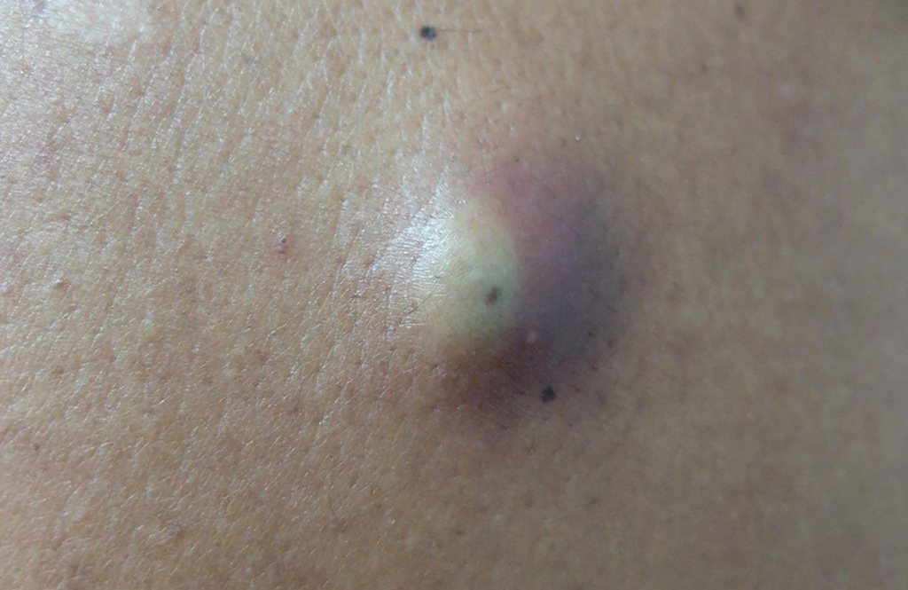 Is it a cyst?