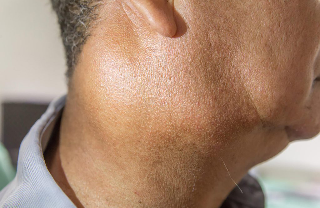 Is it a swollen lymph node?