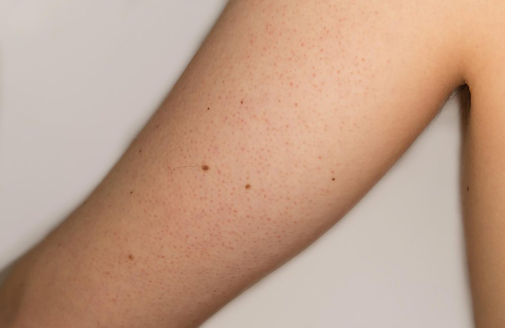 Is it keratosis pilaris?