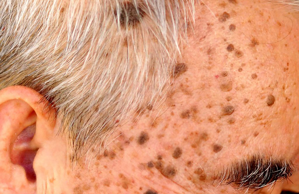 Is it seborrheic keratosis (SK)?