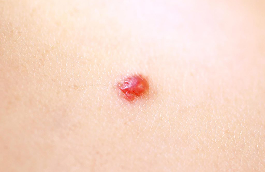 Is it a cherry angioma?