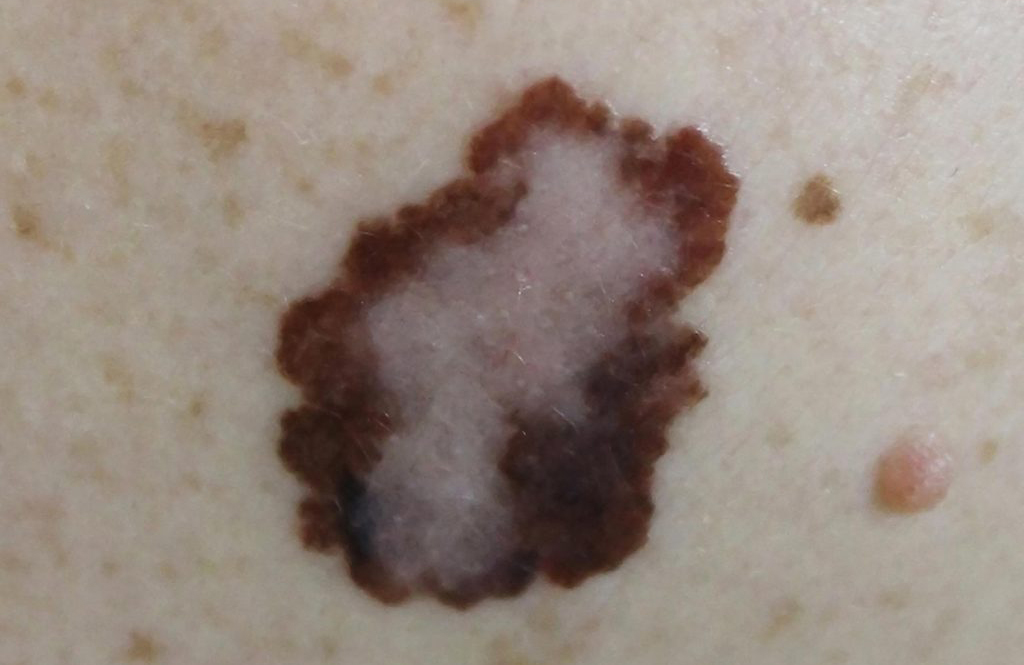 Is it skin cancer?