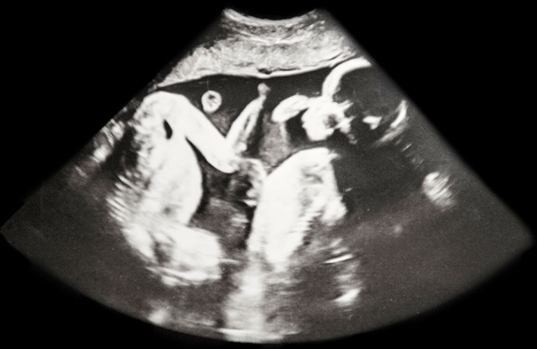 Twins bond in the womb
