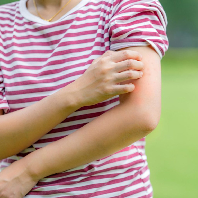 Soothe insect bites