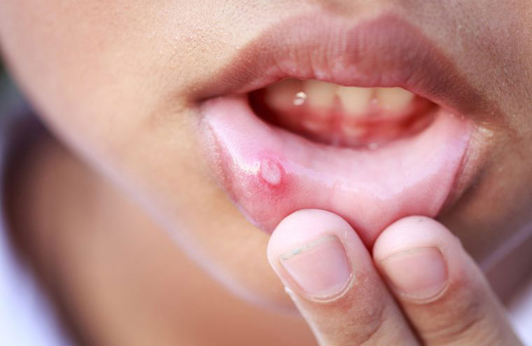 Cracks and sores in your mouth