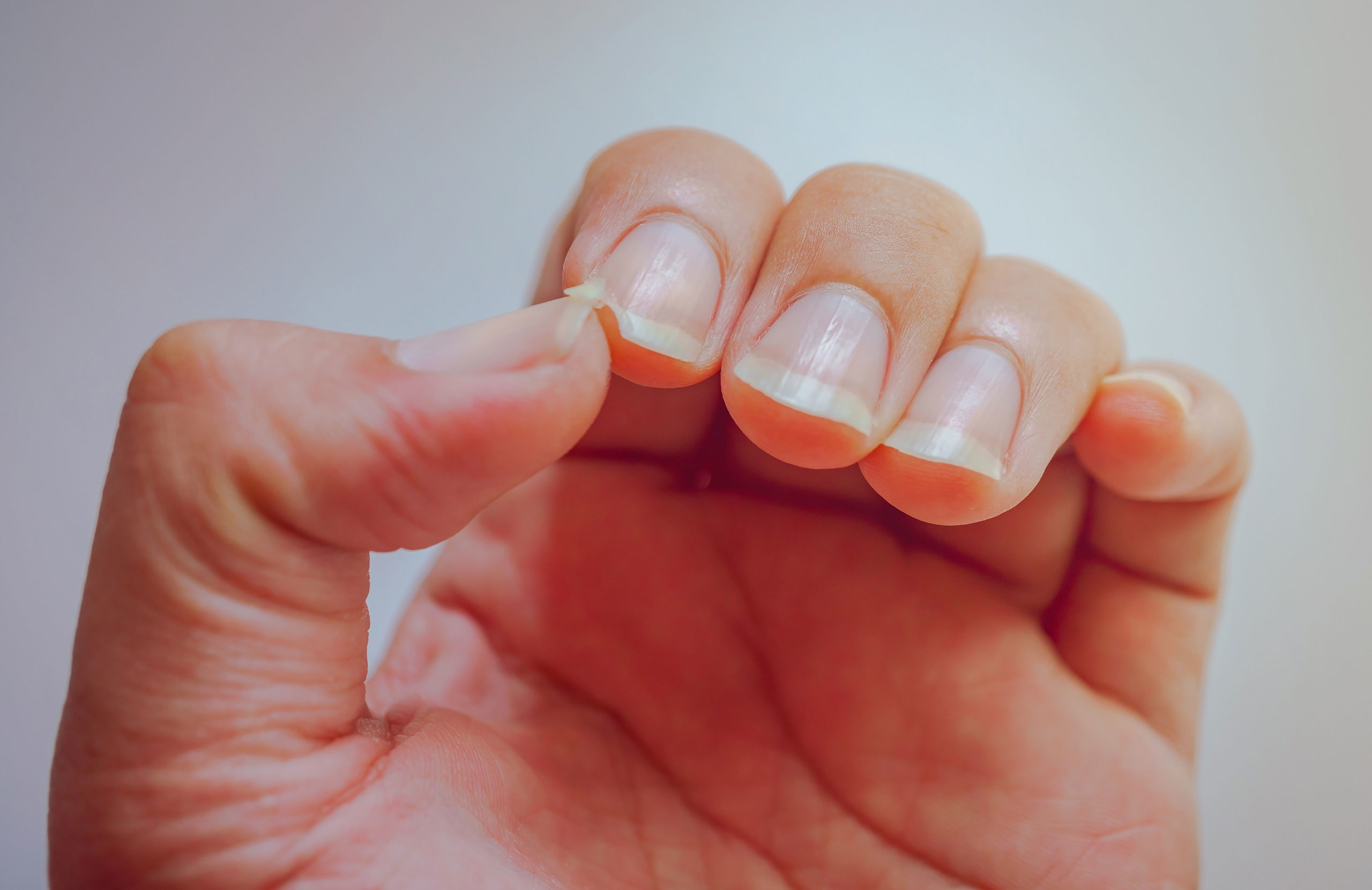 Fingernail ridges